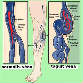 mikrosebészeti műtét visszér venotonikus kenőcsök a visszér ellen