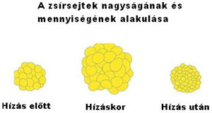 Zsírleszívás