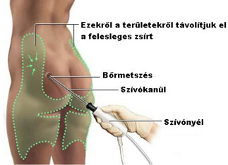 Zsírleszívás