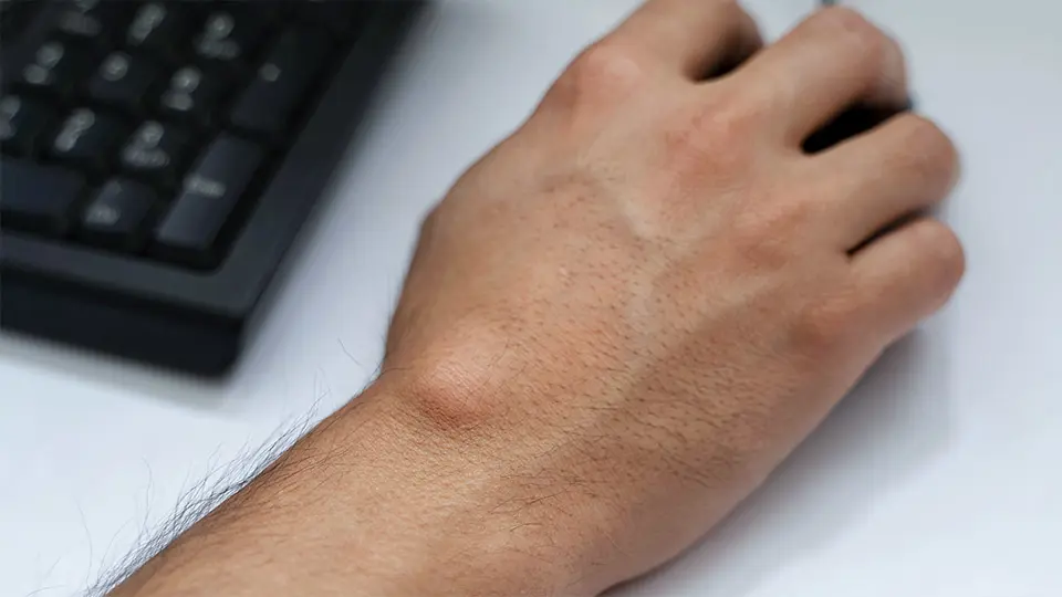 Ganglion